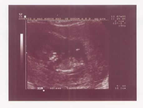 Ender at 3 months into the pregnancy